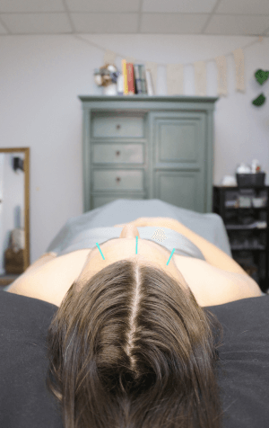 Acupuncture in Costa Mesa CA