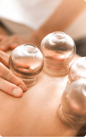 Cupping Therapy in Costa Mesa CA