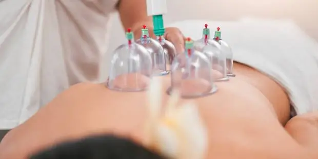 Best Cupping Therapy in Costa Mesa CA